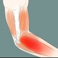 Helbred en sår arm
